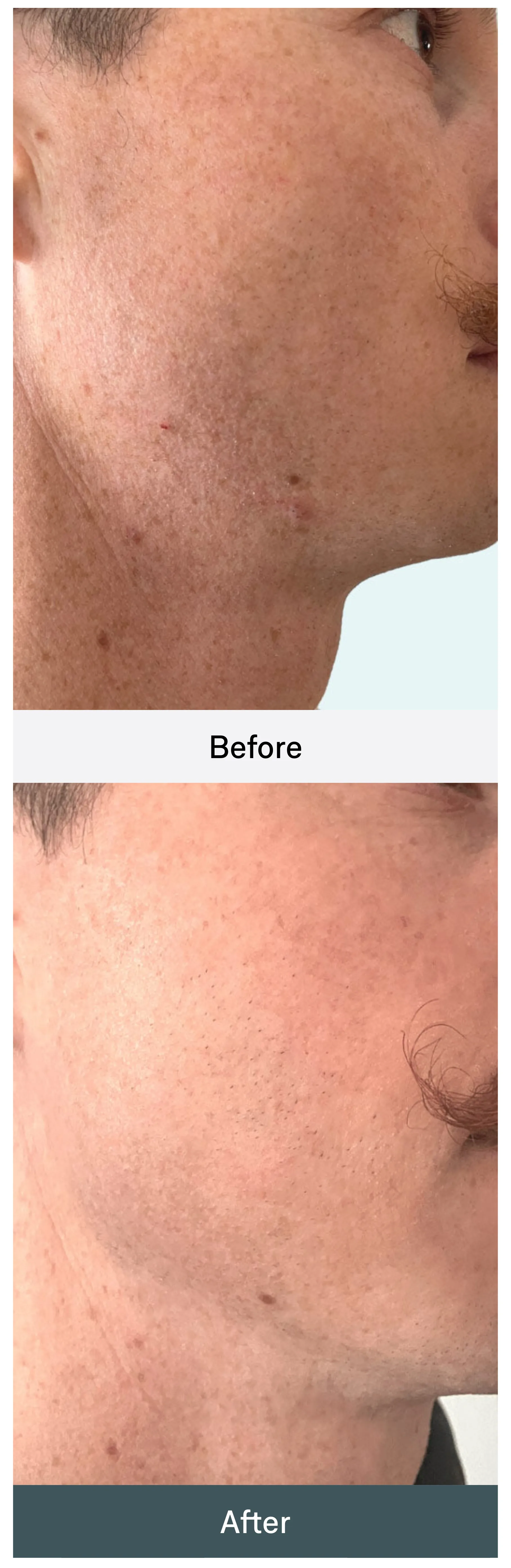 Before and After: a man's cheek and jaw in profile, close on the skin.