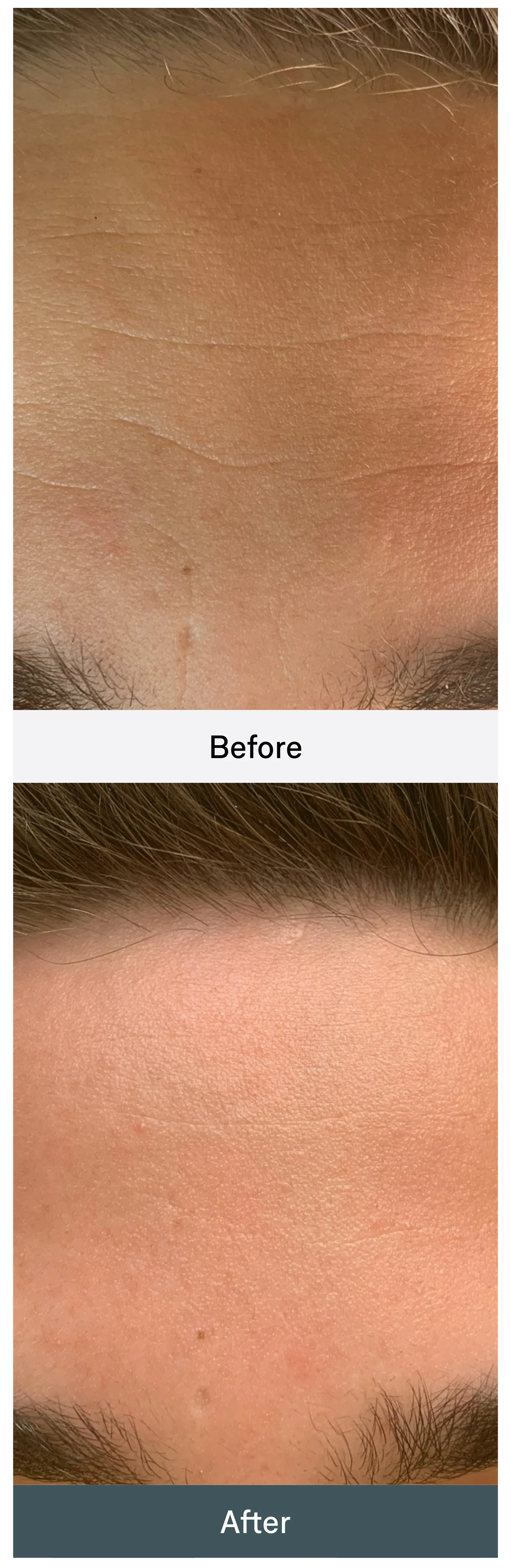 Before and After: a man's forehead above the brows, close on the skin.