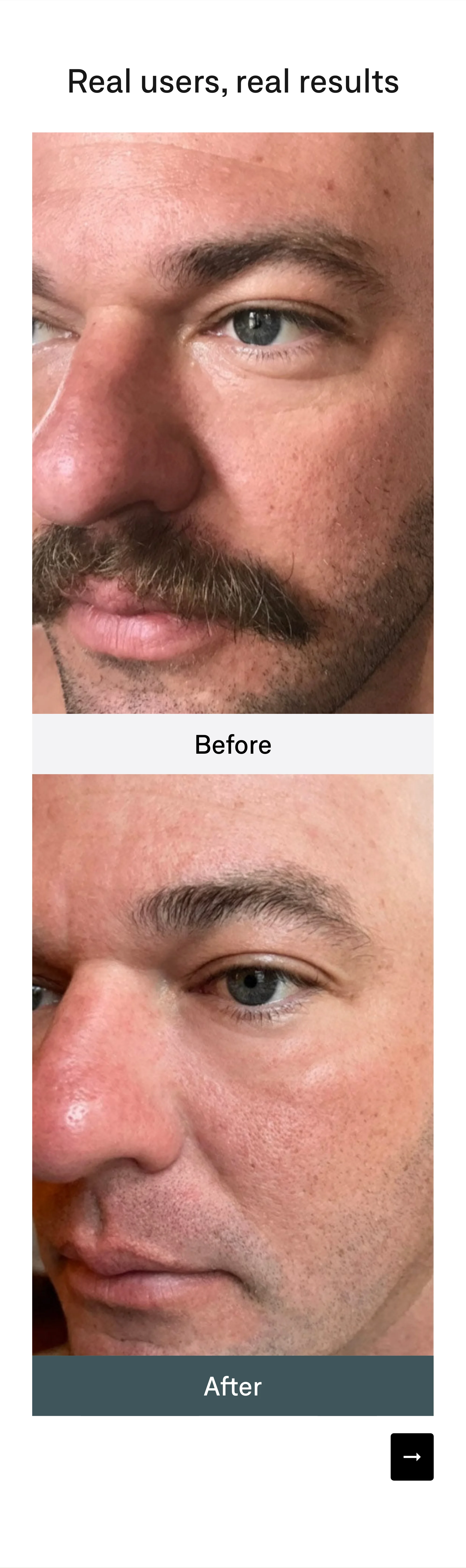 Real users, real results: a before photo and an after photo of a man's face, close on the eye, cheek and jaw, with a next arrow.